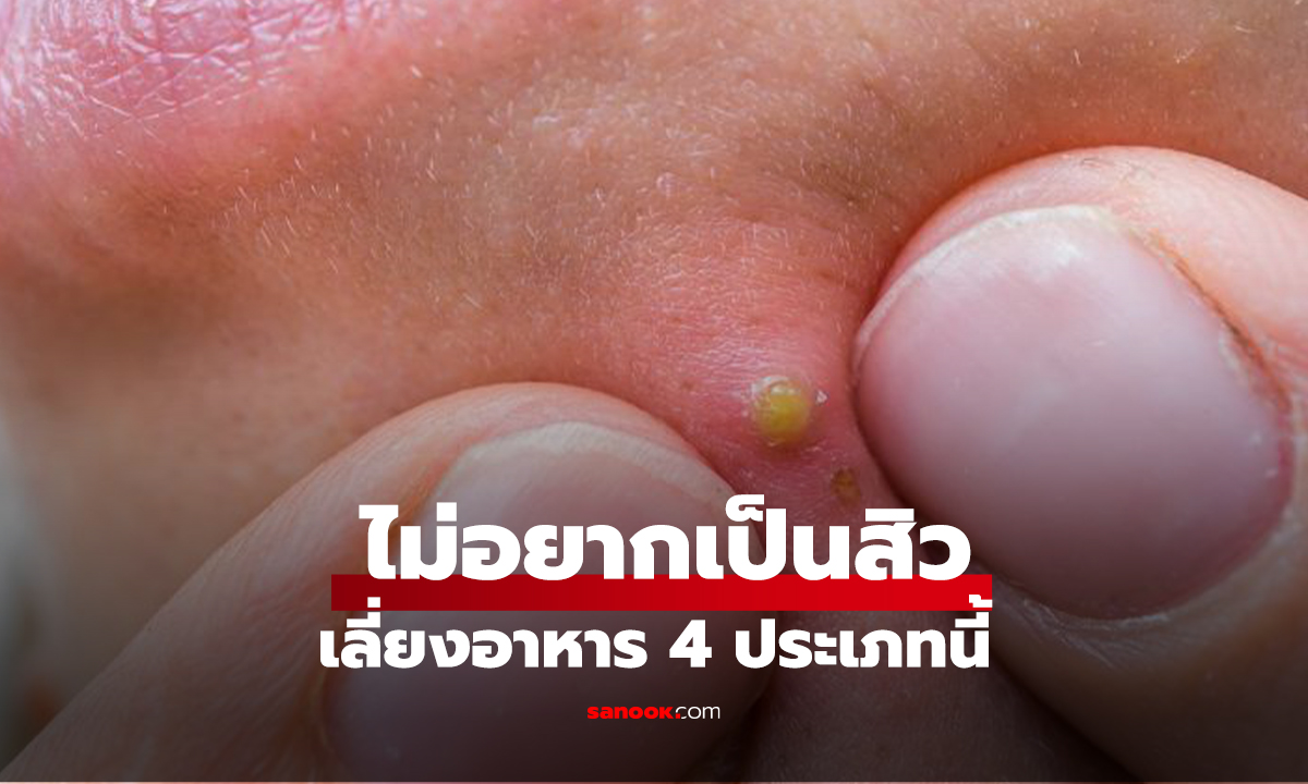 ไม่อยากเป็นสิว เลี่ยงอาหาร 4 ประเภทนี้ ตัวกระตุ้นผิวอักเสบ หน้าเห่อซ้ำแล้วซ้ำอีก