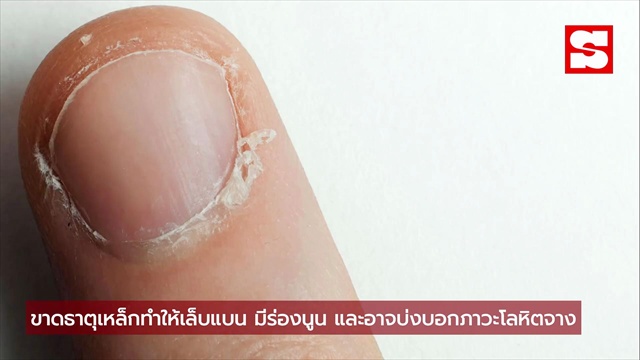 เล็บนูนแข็งเป็นเส้น สัญญาณบอกโรค