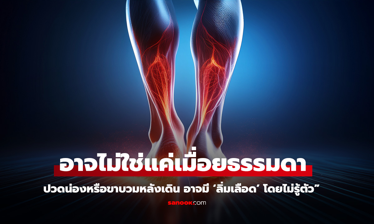 4 สัญญาณอันตราย! เดินแล้วอาจมี ลิ่มเลือด โดยไม่รู้ตัว