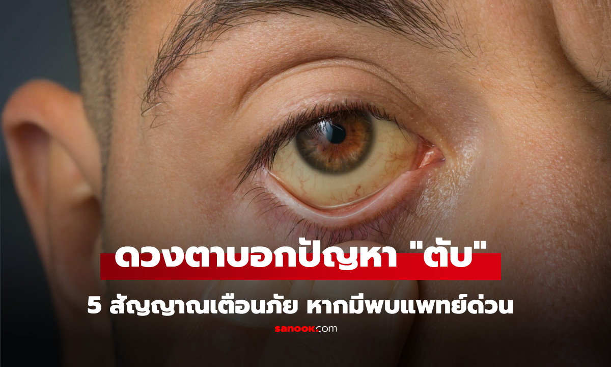 ดวงตาบอกปัญหา "ตับ" เช็ก 5 สัญญาณเตือนภัย เจอแบบนี้รีบไปพบแพทย์ด่วน