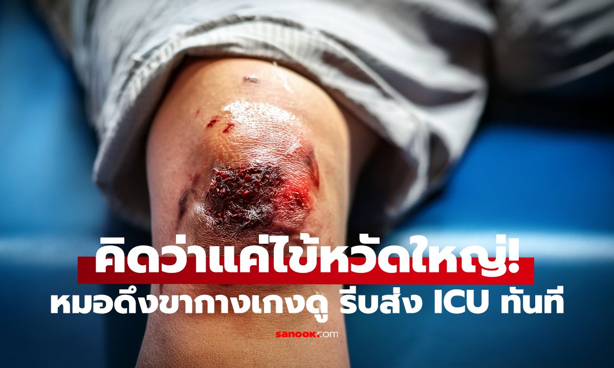 ไข้กลับธรรมดา? ไม่ใช่! สัญญาณที่ขา ทำหมอร้องลั่น