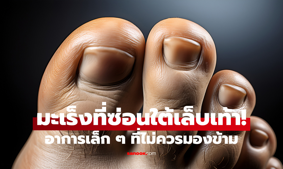 สัญญาณมะเร็งที่ซ่อนใต้เล็บเท้า! แพทย์เตือน อาการเล็ก ๆ ที่ไม่ควรมองข้าม
