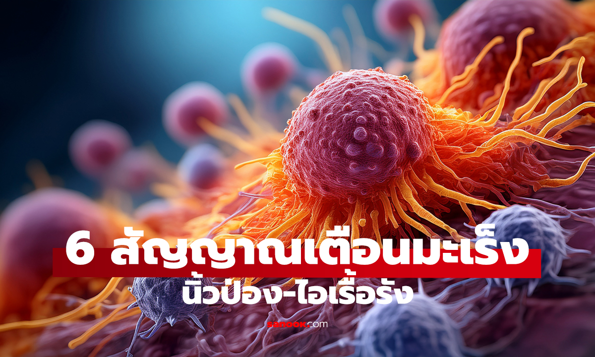 ไม่เจ็บ ไม่เหนื่อย แต่มะเร็งระยะสุดท้าย! หมอย้ำ 6 สัญญาณเตือน นิ้วป่อง-ไอเรื้อรัง