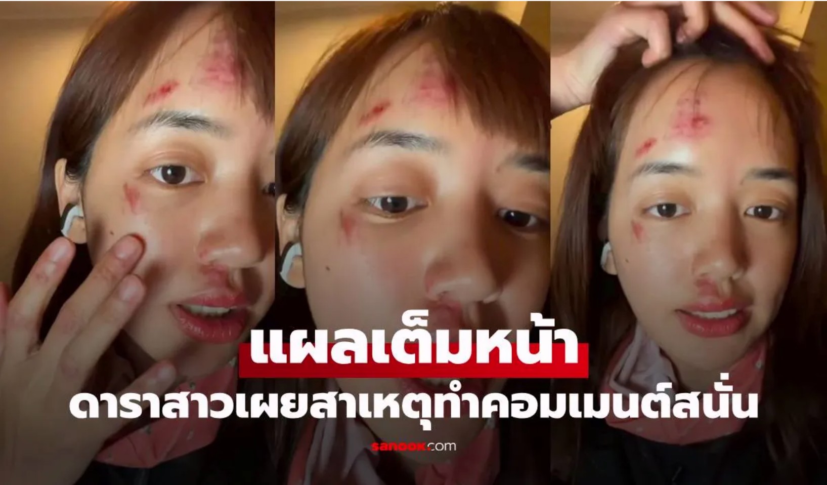 เห็นแล้วตกใจ! ดาราสาวแผลเต็มหน้า หลังล่องเรือขั่วโลก สาเหตุทำคอมเมนต์สนั่น