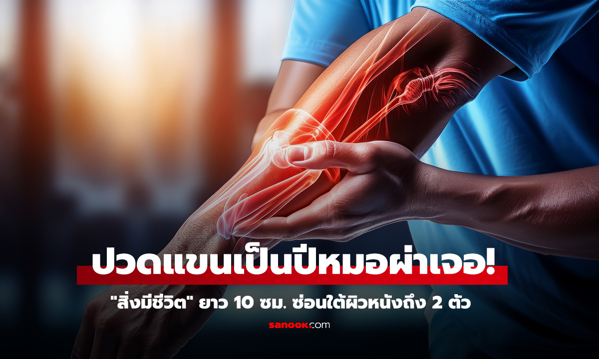 สาวปวดแขนนาน 1 ปี ผ่าตัดเจอสิ่งมีชีวิต 10 ซม. ซ่อนใต้ผิวหนัง