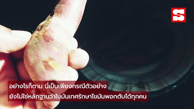 หมอเผยเคส ใบมันเทศกิน 3 เดือน ค่าตับและน้ำตาลดีขึ้น
