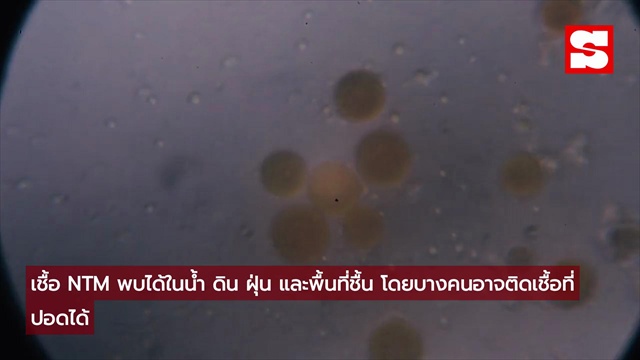 ไอเรื้อรัง 3 ปี ไม่ใช่มะเร็ง แต่เจอต้นเหตุ จากของใช้ใกล้ตัวในห้องน้ำ