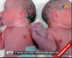 เด็กแฝด คลอดออกมา จับมือประสานกันแน่น