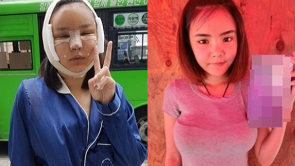 น้องเนย เเฟนเก่ง ลายพราง โพสต์คลิปผ่าตัดเสริมหน้าอก 350 ซีซี เเละศัลยกรรมใบหน้าที่เกาหลี