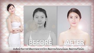 โรงพยาบาลไอดี ศัลยกรรมเกาหลี : คลิปก่อนหลังทำศัลยกรรมขากรรไกร โครงหน้า