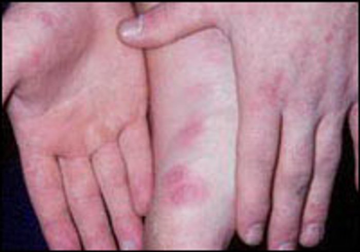 โรคมือเท้าปาก Hand foot and-mouth disease (HFMD)