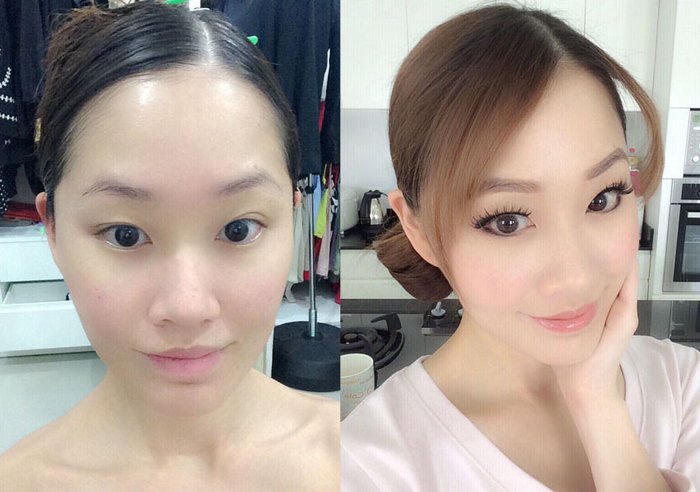 รีวิวการฉีด Filler ฉีดปุ๊บหน้าหายแบน แถมได้มิติทันที มาชมผลลัพธ์กันค่ะ