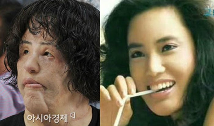 สยอง สาวคลั่งทำศัลยกรรม ฉีดน้ำมันพืช เข้าหน้าตัวเอง