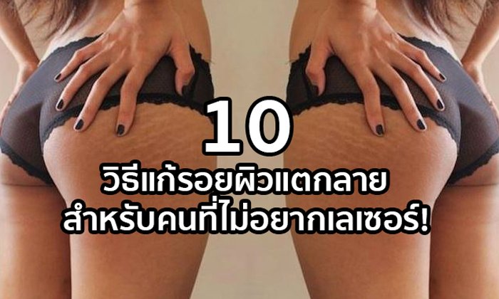 10 วิธีแก้รอยผิวแตกลาย สำหรับคนที่ไม่อยากเลเซอร์!