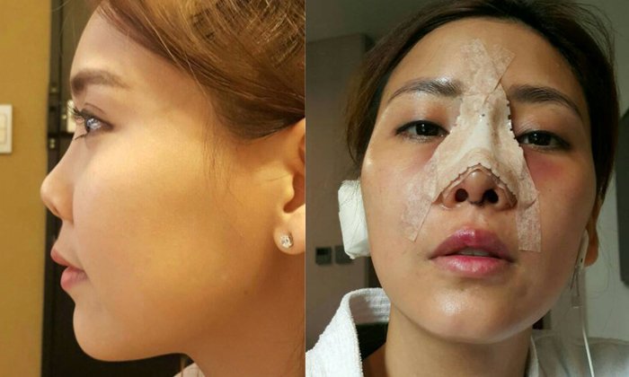 รีวิว ศัลยกรรมแก้จมูก สวยหรือพัง ตามมาดู