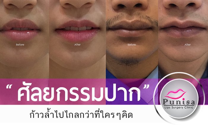 ศัลยกรรมปาก ก้าวล้ำไปไกลกว่าที่ใครๆคิด