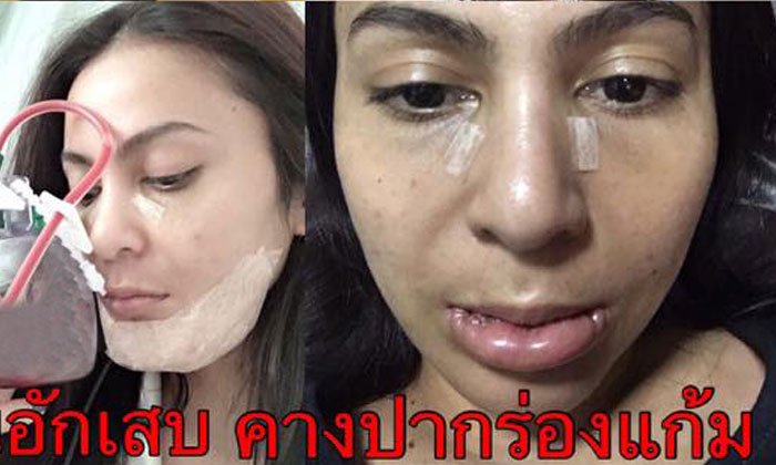 แชร์ประสบการณ์ พิษศัลยกรรม ทำหน้าพัง ไม่สวยดังฝัน
