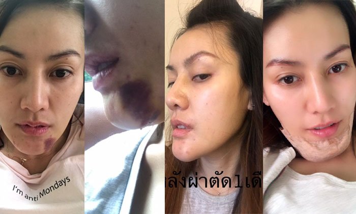 ประสบการณ์จริงจากนางแบบสาว ทำคางพลาด ปากเบี้ยวจนติดเชื้อ