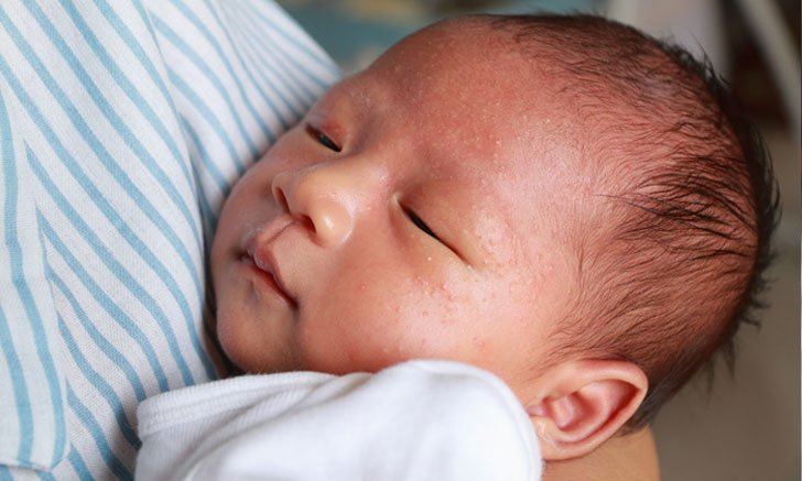 ผื่นจากผ้าอ้อมเกิดจากอะไร มีวิธีรักษาและป้องกันได้อย่างไรบ้าง?