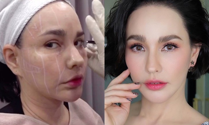 ซูมรูขุมขุนคนดัง หลังทำผิวที่เกาหลี ผิวเนียน หน้าเด็กมาก!