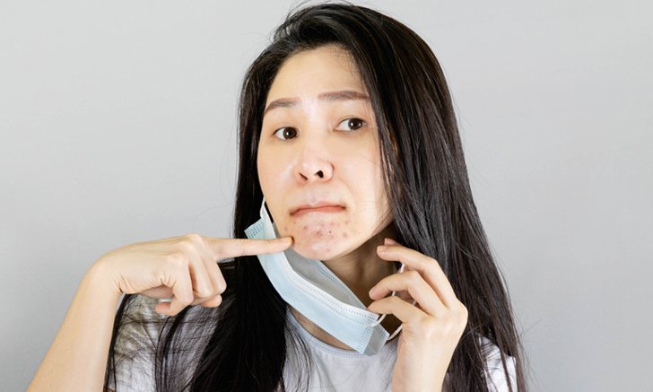 6 วิธีดูแลผิวให้ห่างไกลสิว แม้ต้องใส่หน้ากากอนามัยทุกวัน