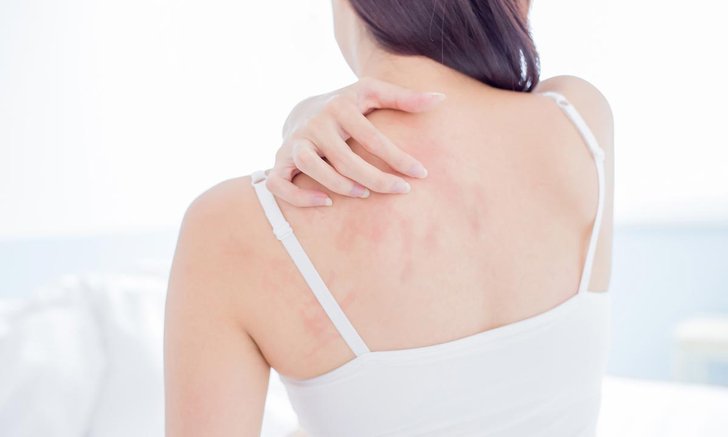 7 วิธีแก้รอยดำที่เกิดจากการเกา อยากผิวใสไร้ตำหนิ ต้องลอง
