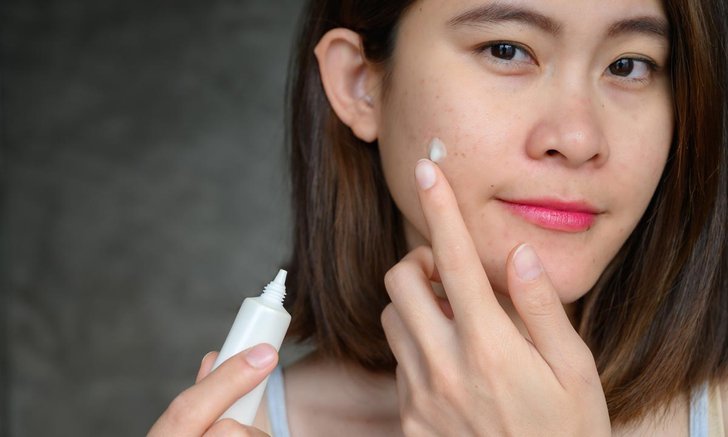 รักษาสิวให้หายใน 1 วัน ด้วย 7 ไอเทมที่เป็นมิตรต่อผิว