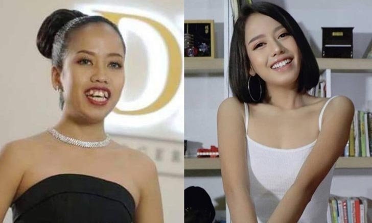 "ตุ๊ก เดอะว้าวลาว" หลังจัดฟัน งามหลาย ลืมลุคเดิมไปเลย