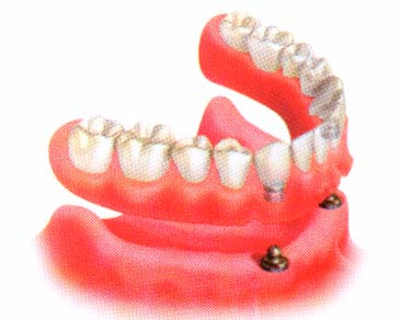 รากฟันเทียม