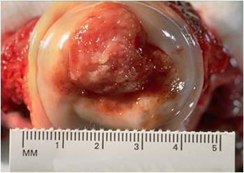 มะเร็งปากมดลูก