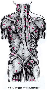 Trigger Point หรือจุดกดเจ็บ