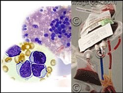 มะเร็งเม็ดเลือดขาว - ลิวคีเมีย, ลูคีเมีย, Leukemia