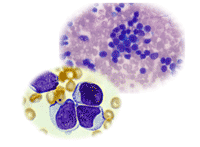 มะเร็ง, CANCER, มะเร็งเม็ดเลือดขาว, มะเร็งในเม็ดเลือดขาว, ลิวคีเมีย, ลูคีเมีย, LEUKEMIA, LEUKEAMIA