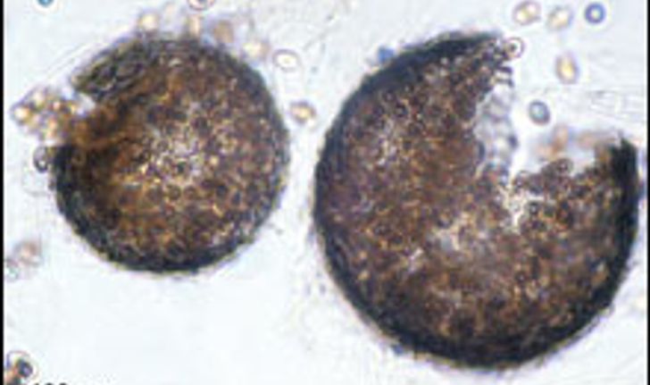 เชื้อรามรณะPseudallescheria boydii