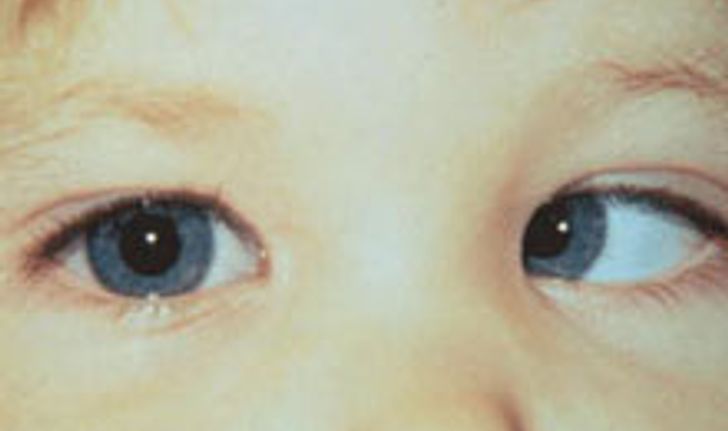 เด็กเล็กตาเขตาเหล่ให้ระวังมะเร็งขึ้นจอตา