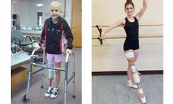 ความพิการไม่ใช่อุปสรรค ! สาวน้อยยังเต้นบัลเลต์ต่อ แม้ต้องใส่ขาเทียม