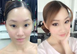 รีวิวการฉีด Filler ฉีดปุ๊บหน้าหายแบน แถมได้มิติทันที มาชมผลลัพธ์กันค่ะ 