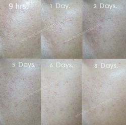 [ ❤ แชร์ประสบการณ์ ❤ ] ทำ Fraxel Fine Treatment สุดยอดวิทยาการย้อนวัยเยาว์ 