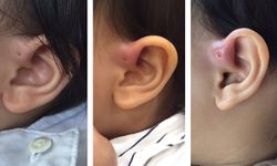 ภัยเงียบกับโรค Ear pit รูเล็กๆข้างหู ในเด็กอายุ 1 ปี