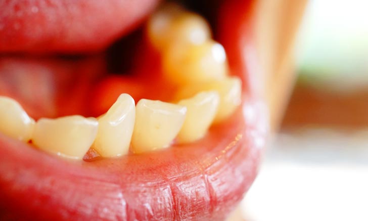 รู้ทันอาการฟันตาย โรคอันตรายที่เกิดขึ้นในช่องปาก