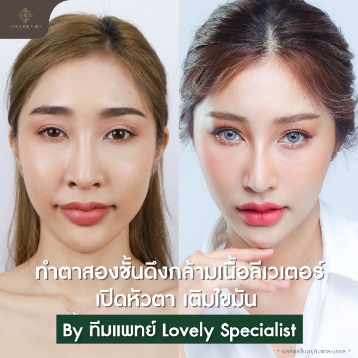 ส่องเคสศัลยกรรมตาสวยสายฝอ ของสาวงาม 3 สไตล์ที่ Lovely Eye & Skin Clinic