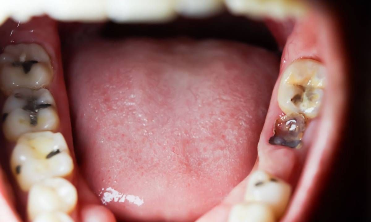 "ฟันตาย" คืออะไร เกิดจากอะไร และจะแก้ไขได้อย่างไร