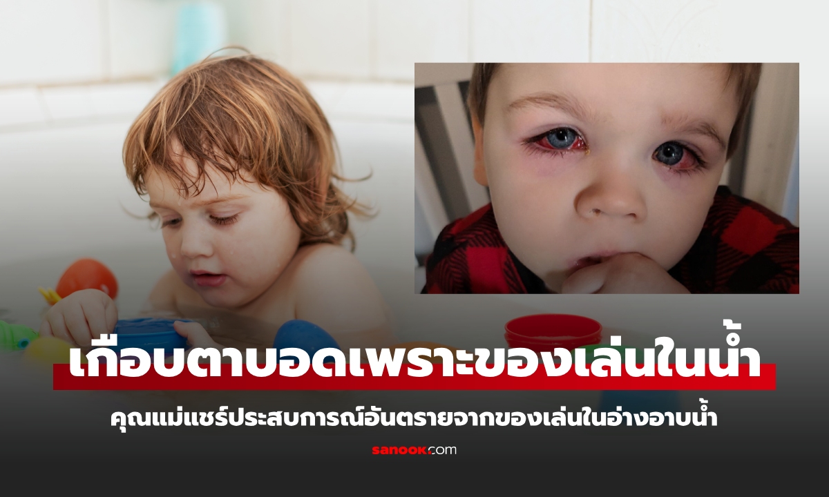 คำเตือนจากแม่! ลูกชายหวิดตาบอดเพราะของเล่นในอ่างอาบน้ำ