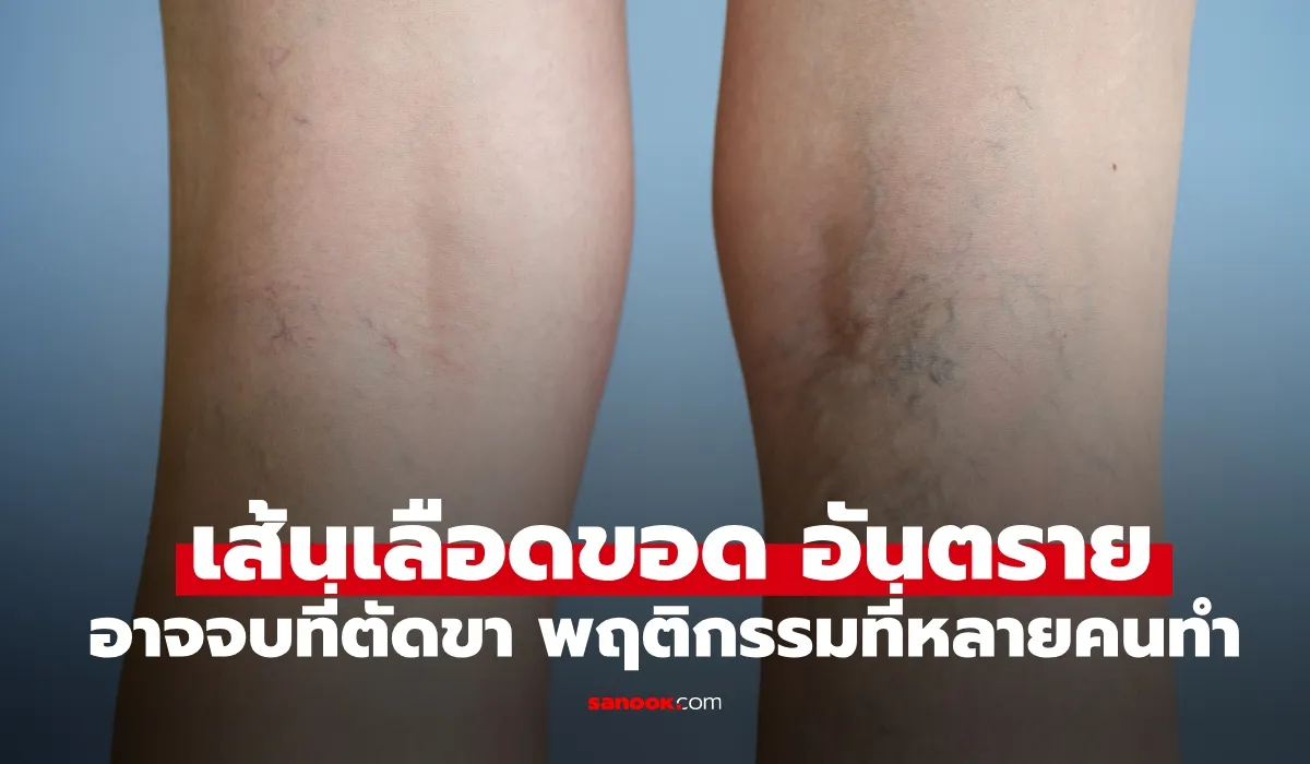 รวมวิธีป้องกันเส้นเลือดขอด สำหรับคนทำงานที่ต้องยืน/นั่งนาน เลี่ยงอันตรายถึงชีวิต รวมวิธีป้องกันเส้นเลือดขอด สำหรับคนทำงานที่ต้องยืน/นั่งนาน เลี่ยงอันตรายถึงชีวิต