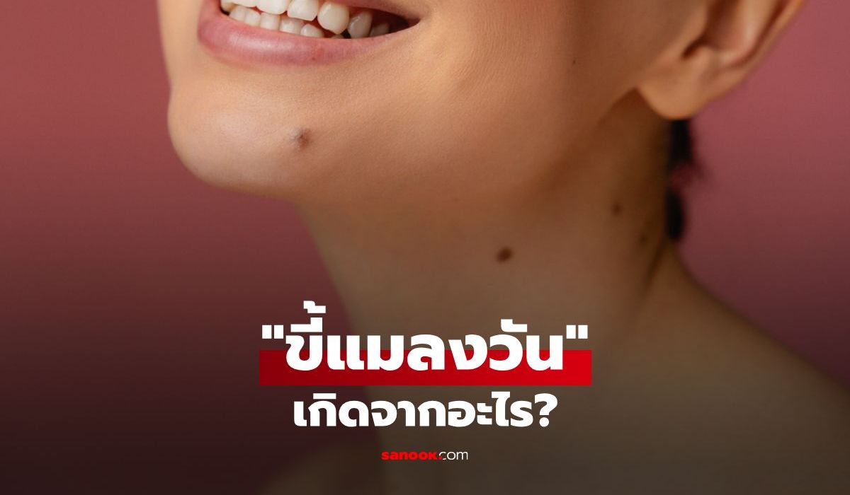 ขี้แมลงวันเกิดจากอะไร? จุดเล็กบนผิวที่บ่งบอกสุขภาพ