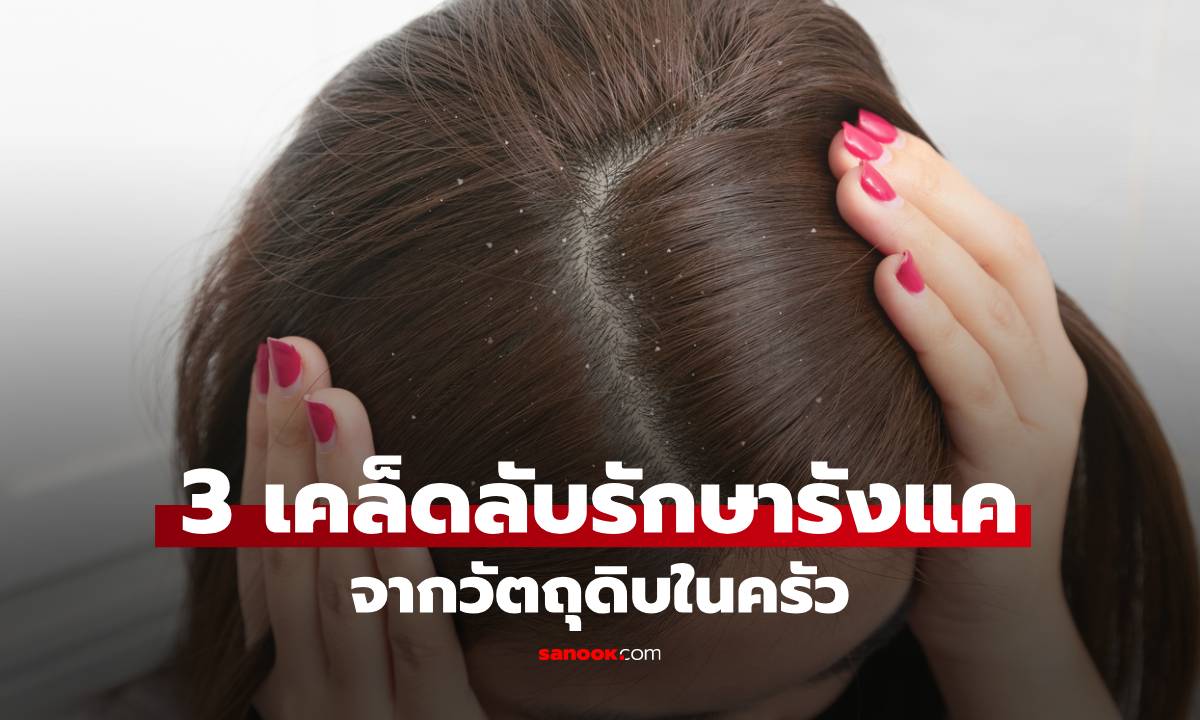 3 เคล็ดลับรักษารังแคที่บ้านจากวัตถุดิบในครัว ได้ผลอย่างน่าประหลาดใจ
