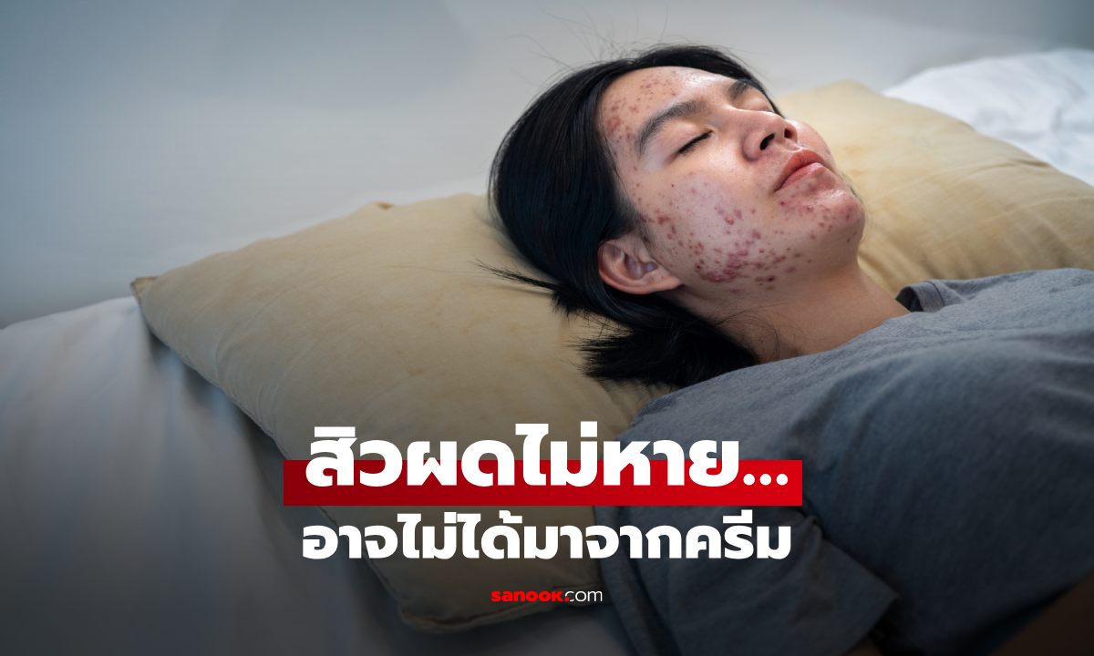 สิวผดขึ้นกรอบหน้าไม่หยุด ต้นเหตุอาจอยู่ที่ “ปลอกหมอน”