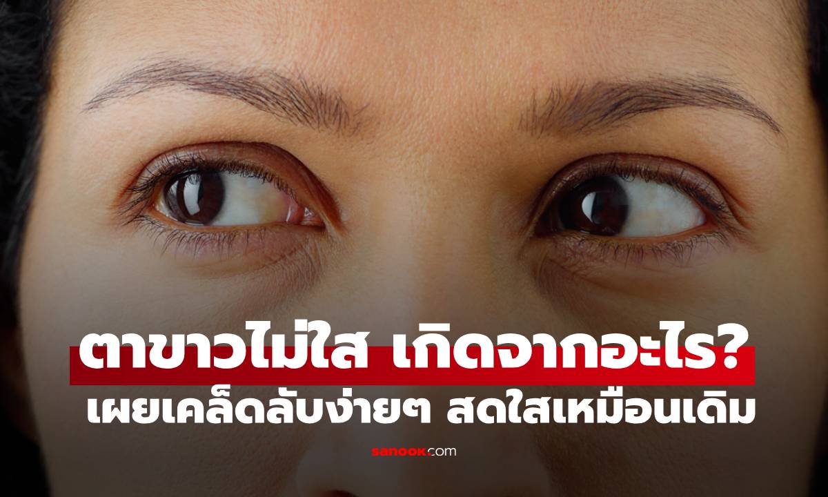 ตาขาวไม่ใส เกิดจากอะไร? เผยเคล็ดลับง่ายๆ ทำให้กลับมาสดใสเหมือนเดิม