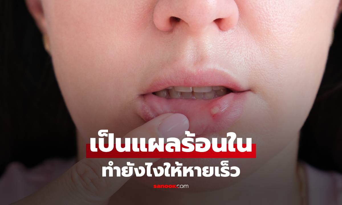 เป็นแผลร้อนใน ทำยังไงให้หายเร็ว รวมวิธีดูแลทำแล้วได้ผลจริง
