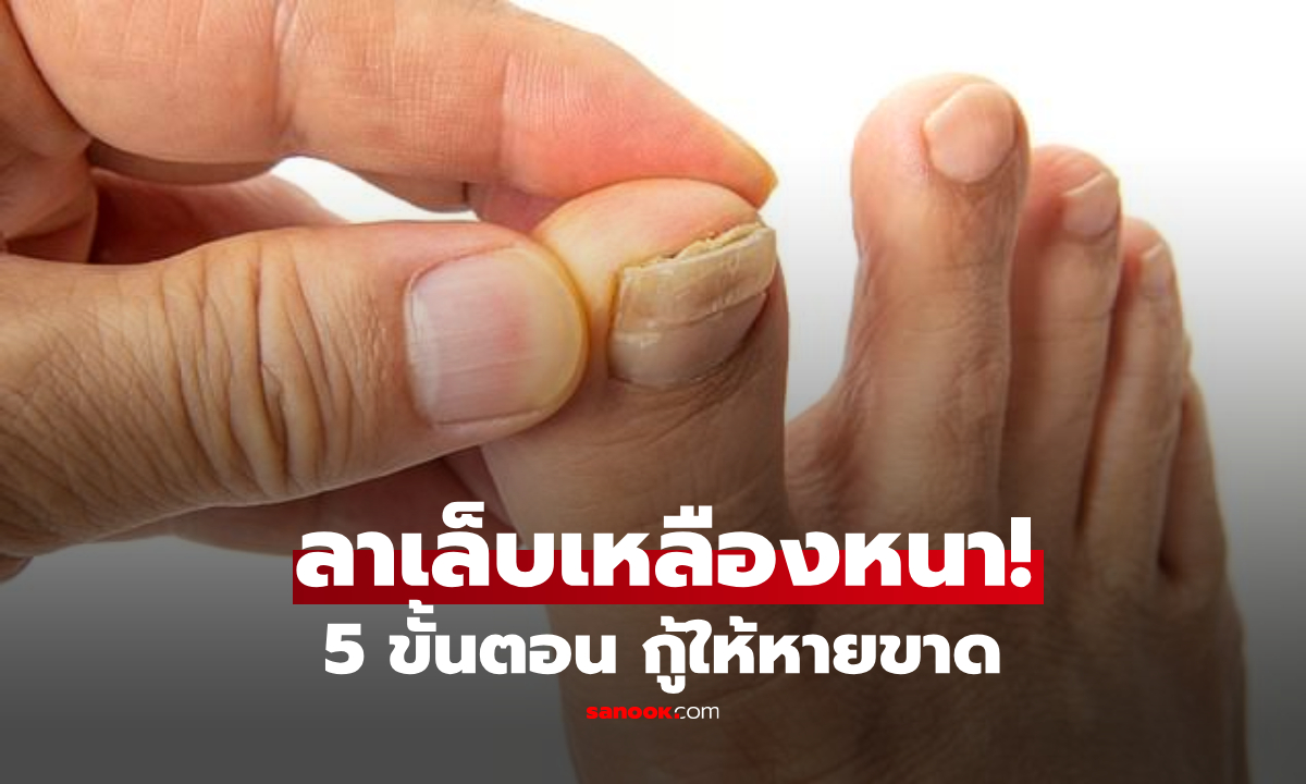 สูตรแพทย์ 5 สเตปกำจัด "เชื้อราเล็บเท้า" ให้หายขาด บอกลาเล็บเหลืองหนา กลับมาเนียนกริบ!